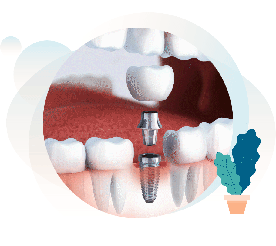 dental implant 3